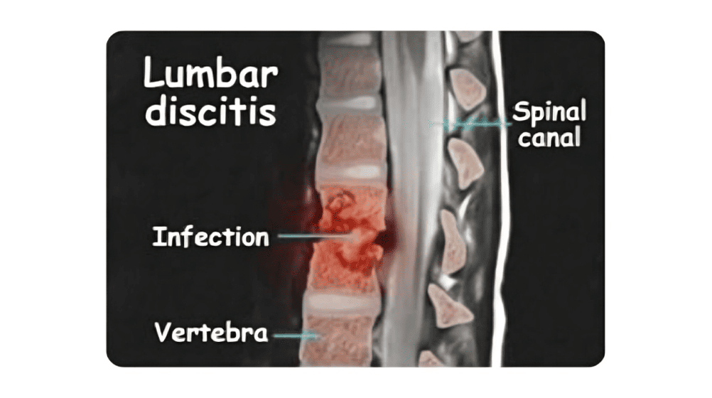 Spondylodiscitis Treatment in Delhi NCR | Dr. Sanyam Jain | Best Spine Surgeon in Delhi NCR