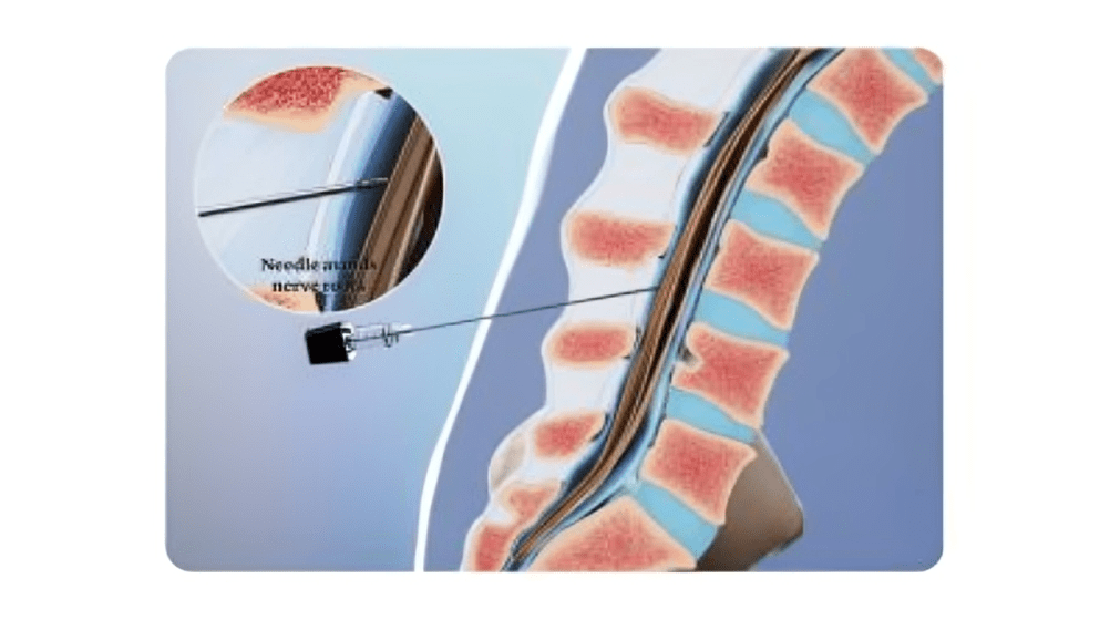 Spinal Injection Treatment in Delhi NCR | Dr. Sanyam Jain | Best Spine Surgeon in Delhi NCR