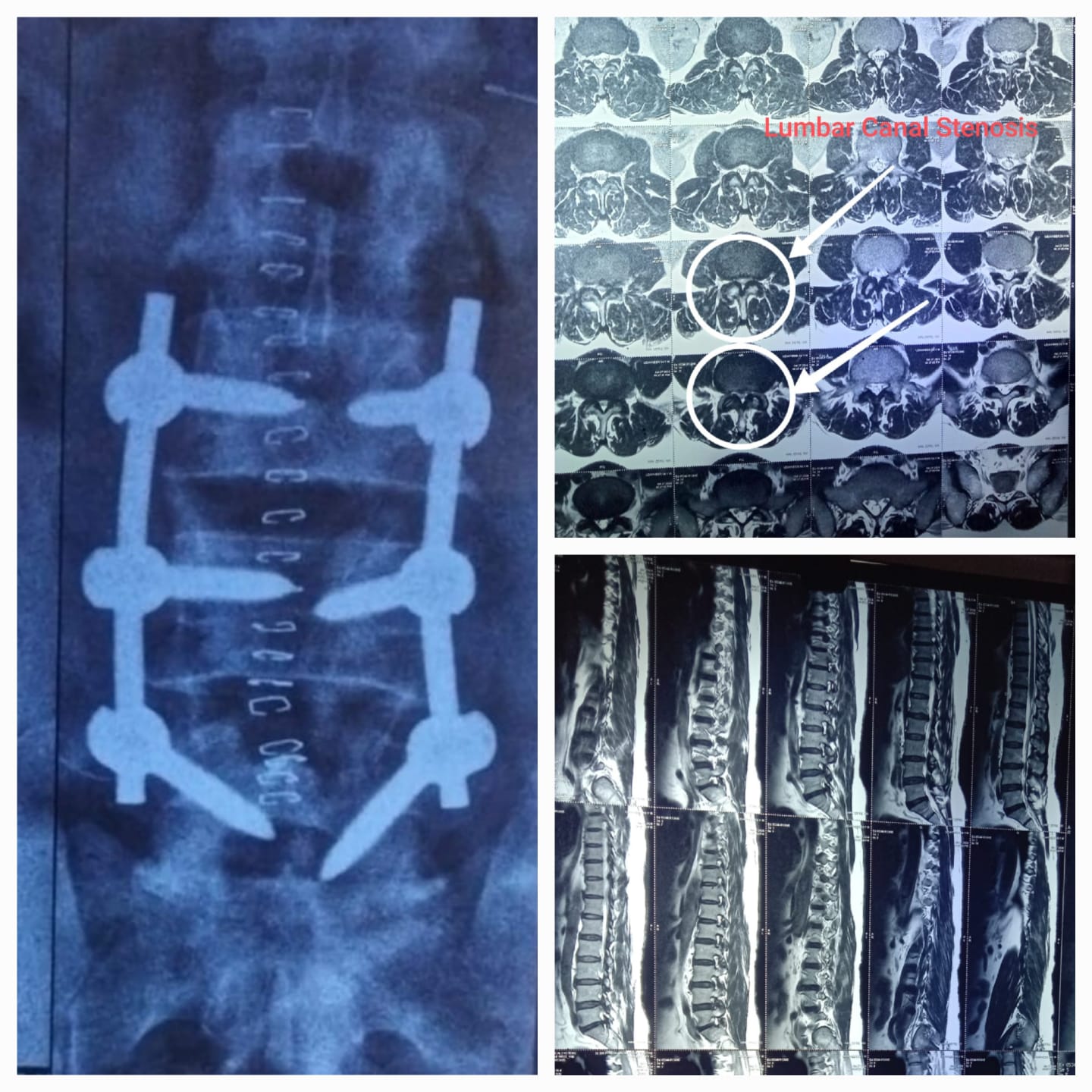 Case 1 - Lumbar Canal Stenosis | Recent Spine Cases | Dr. Sanyam Jain | Best Spine Surgeon in Delhi NCR