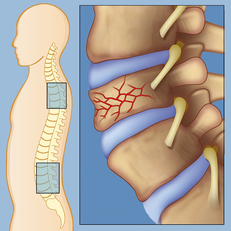 Spinal Fracture Treatment in Delhi NCR | Dr. Sanyam Jain