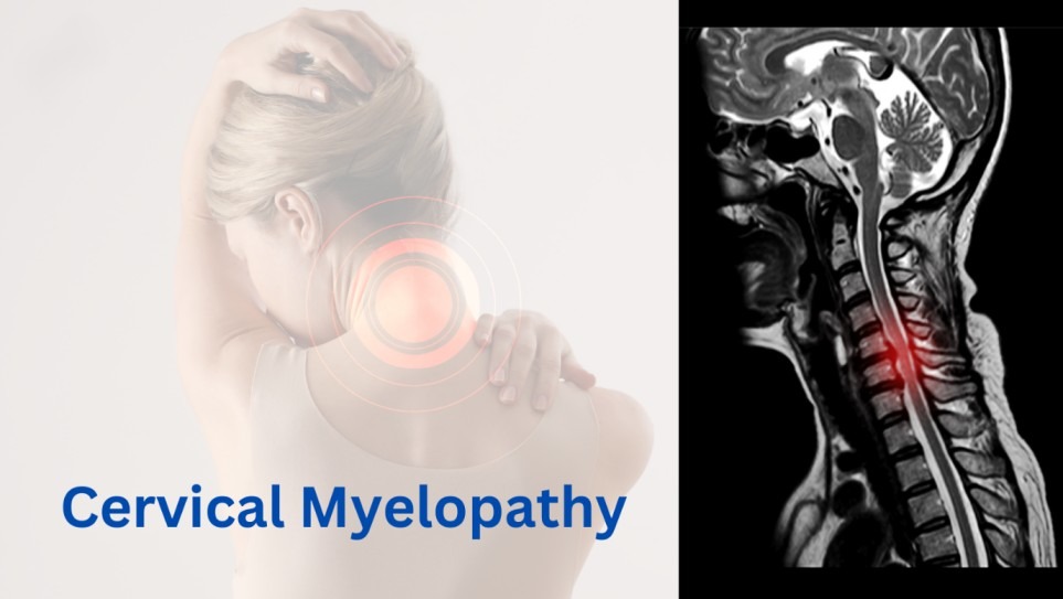 Best Cervical Myelopathy Treatment in Delhi NCR | Dr. Sanyam Jain