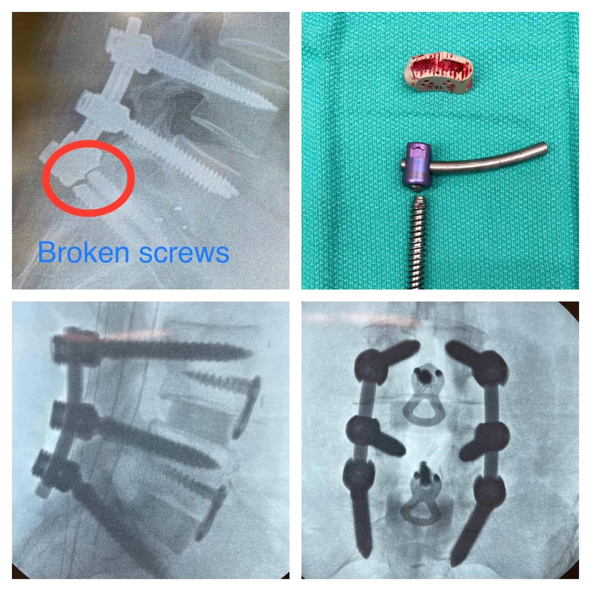 Best Revision Spine Surgery Treatment in Delhi NCR | Dr. Sanyam Jain Best Revision Spine Surgery Treatment in Delhi NCR | Dr. Sanyam Jain | Best Spine Surgeon in Delhi NCR