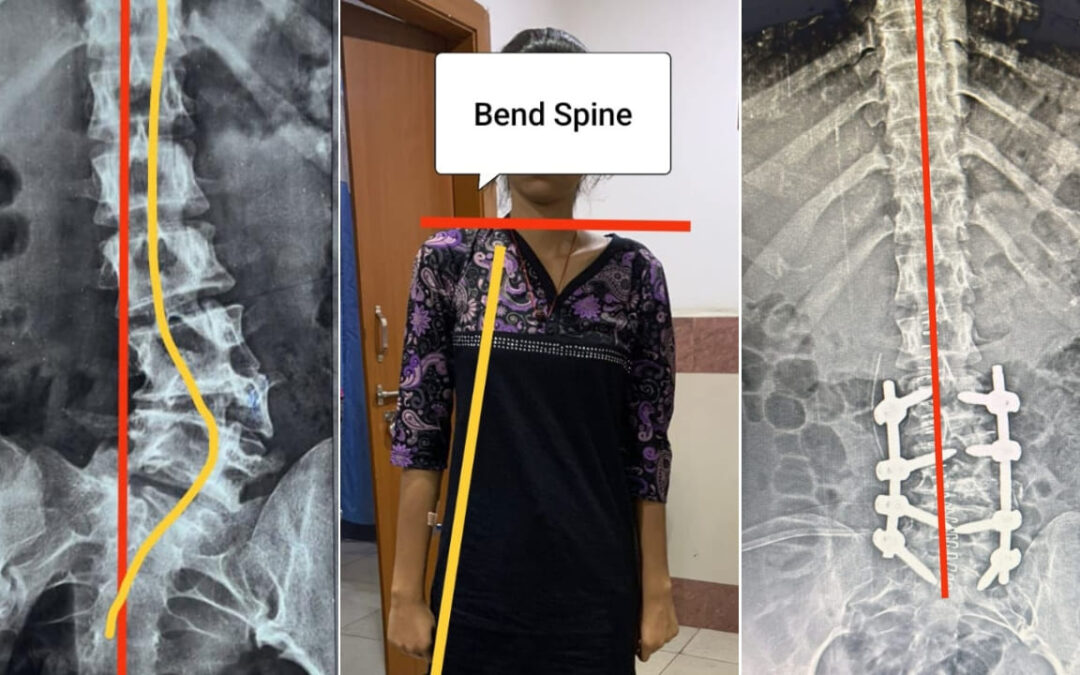 Spine Scoliotic Deformity with Hemivertebrae Case