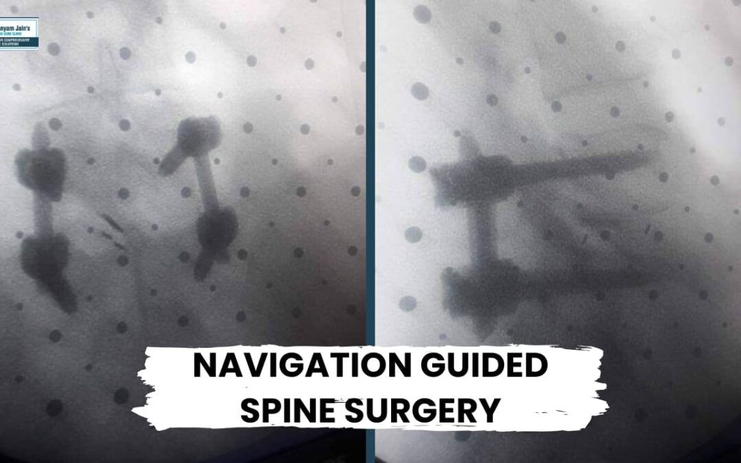 Best Navigation Guided Spine Surgery