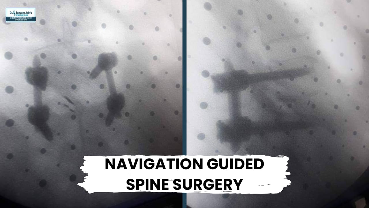 Best Navigation Guided Spine Surgery | Dr. Sanyam Jain | Best Spine Surgeon in Delhi NCR