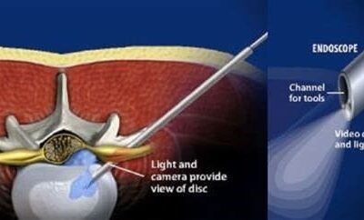 Keyhole Surgery