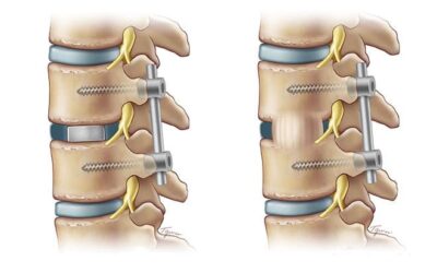 Spinal Fusion Surgery