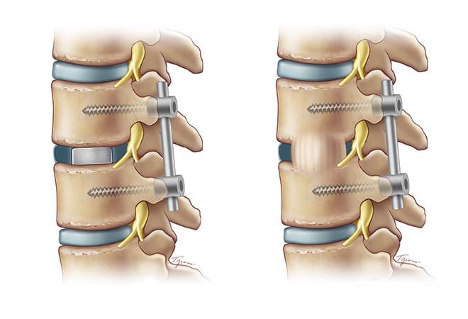Spinal Fusion Surgery